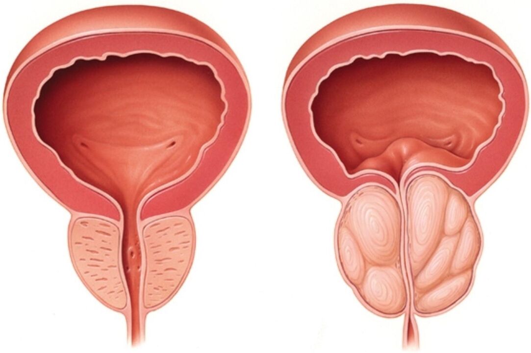 Normal prostate (left) and showing signs of inflammation in prostatitis (right)