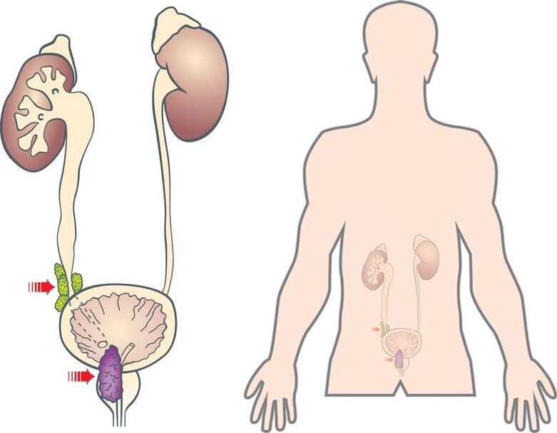 symptoms and causes of prostate adenoma